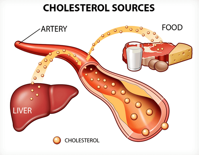 Gan nhiễm mỡ làm gia tăng lượng cholesterol trong máu