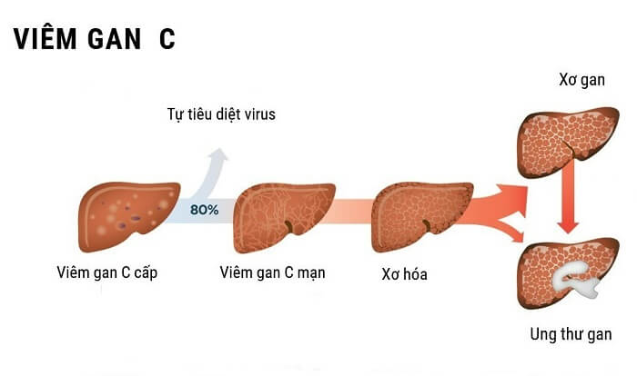 Quá trình hủy hoại gan của virus viêm gan C