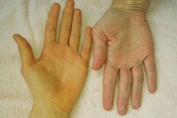 Vàng da là dấu hiệu dễ nhận thấy nhất khi mắc các bệnh lý về gan