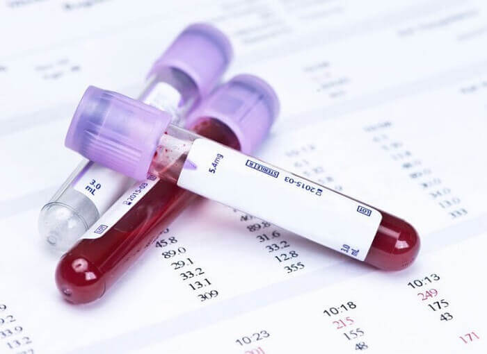 Xét nghiệm máu để chuẩn đoán bệnh xơ gan tốt nhất